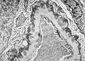 F,40y. | membranous glomerulopathy - lupus erythematodes F,40y. | membranous glomerulopathy - lupus erythematodes